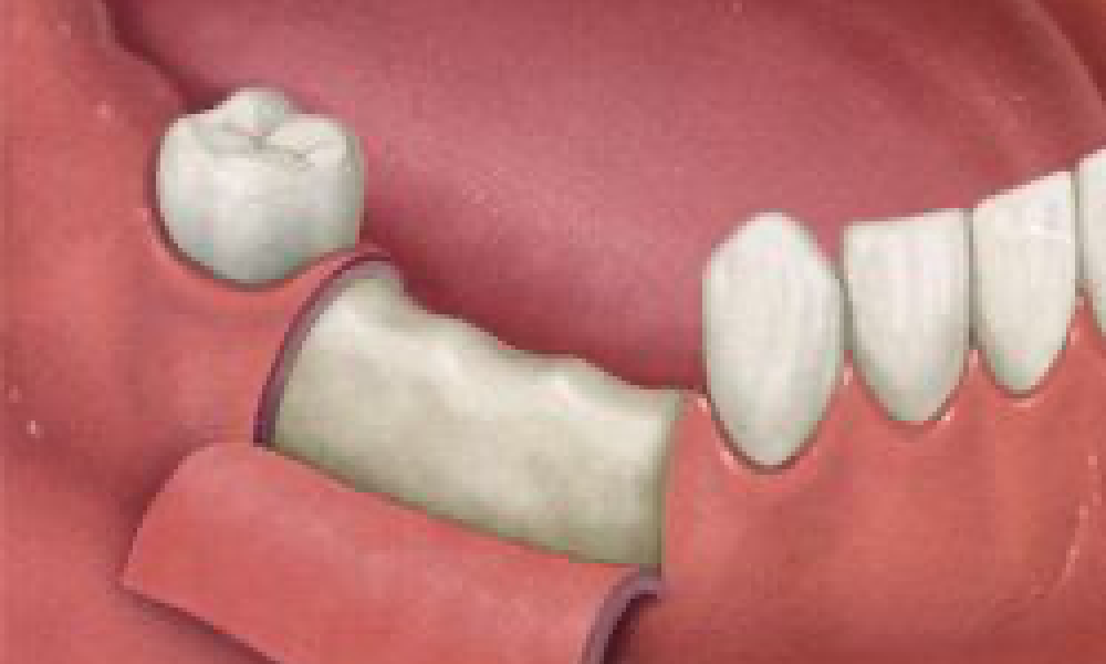 2.歯ぐきを切開してあごの骨に穴を開ける