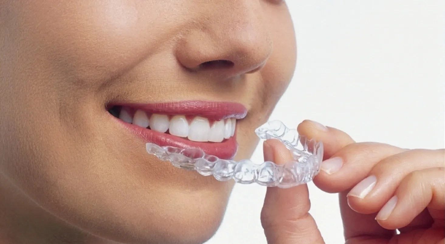 マウスピース矯正