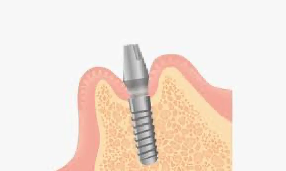 5.人工歯根の頭を露出させる